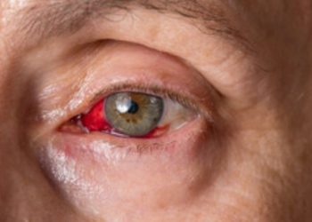 Conjunctivitis: What Is Pink Eye?