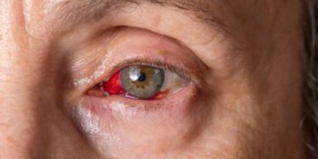 Conjunctivitis: What Is Pink Eye?