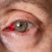Conjunctivitis: What Is Pink Eye?