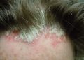 Dandruff & Scalp Psoriasis