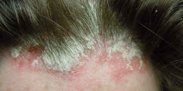 Dandruff & Scalp Psoriasis