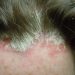 Dandruff & Scalp Psoriasis