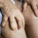 Gout Pain