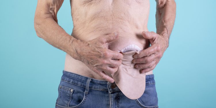 Ulcerative colitis