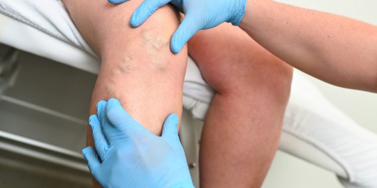 Home Remedies for Varicose Veins