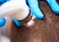 What are Scalp Toners?