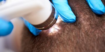 What are Scalp Toners?