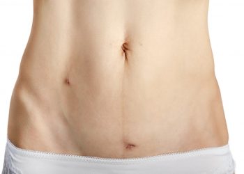 Healing after myomectomy