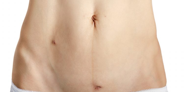 Healing after myomectomy