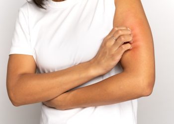 Understanding and Managing Food Allergies